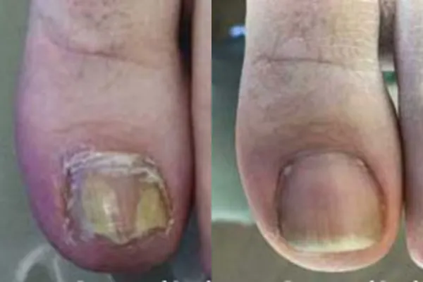 Дерматологічний спрей від запаху та грибку