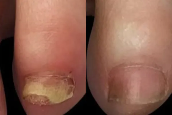 Дерматологічний спрей від запаху та грибку