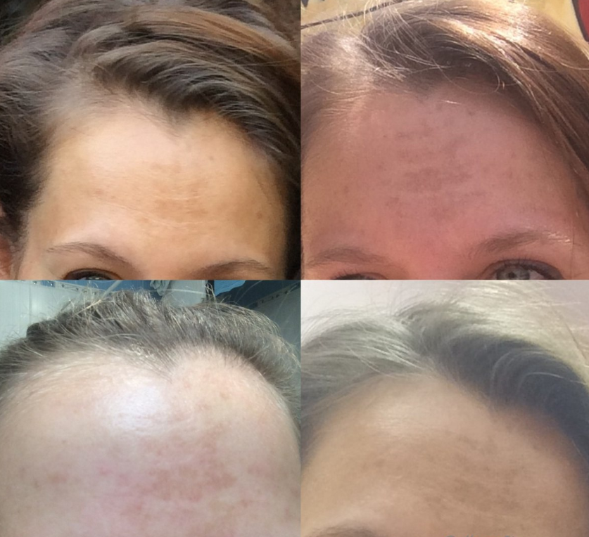 Холодний коректор пігментації