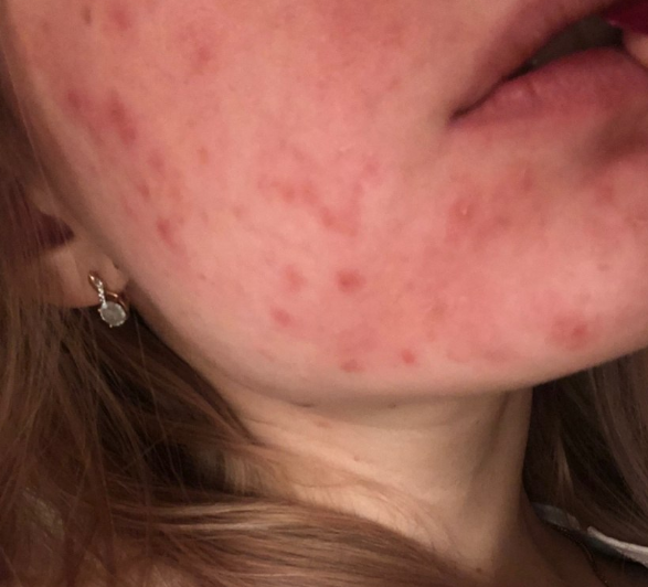 Холодний коректор пігментації